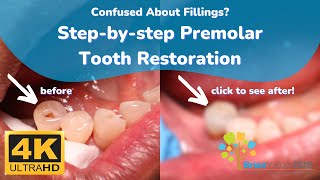 Confused About Fillings Simple StepByStep Restoration of a Large Premolar Tooth Filling [upl. by Erej595]