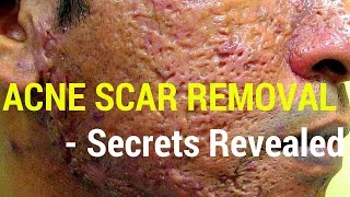 How to treat acne scars Dermatology Secrets revealed [upl. by Kettie]