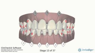 Andrew Chow Invisalign Mid Course Correction [upl. by Sparhawk]