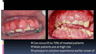 Drug Induced Gingival Enlargement [upl. by Irby746]