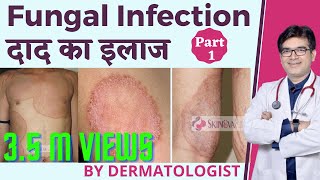 Fungal Infection Treatment In Hindi  फ़ंगल इन्फ़ेक्शन का इलाज हिंदी में  Dermatologist  Dr Sunil [upl. by Tibbetts]