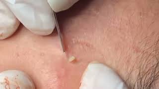 how to remove blackheads from nose with tool removeblackhead [upl. by Ajroj178]