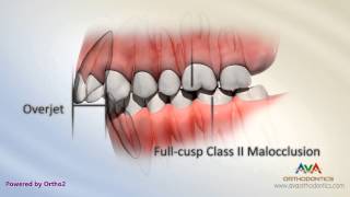 Malocclusion  Class II Div I [upl. by Einnaffit331]