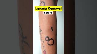 Multiple Lipoma removal  lipoma removal cost shorts [upl. by Mccallion]