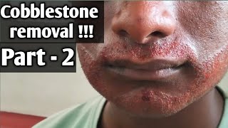 How to cure cobblestones cobblestone removal part 2  tamil [upl. by Adaj307]