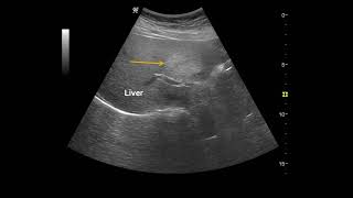 Fatty liver Focal fatty infiltration 지방간 국소적 지방 침착 [upl. by Elvah]