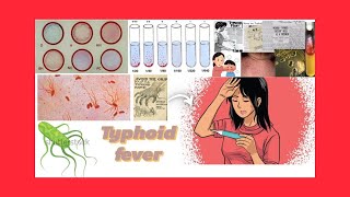 Typhoid fever everything we want to know [upl. by Tellford756]