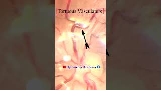 Tortuous Retinal vessels  Fundus Photography  Short Video 107 optometry optometrist [upl. by Octavie88]