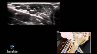 How To Ultrasound Guided Axillary Nerve Block 3D Video [upl. by Akemor]