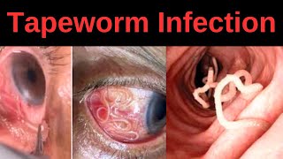 Tapeworm Infection Signs Symptoms Complications [upl. by Singh]