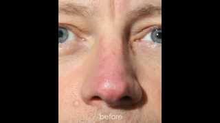 Couperose of the Nose Intense Pulsed Light IPL Treatment [upl. by Htenek]