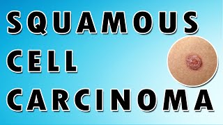 Squamous Cell Carcinoma [upl. by Alyss772]