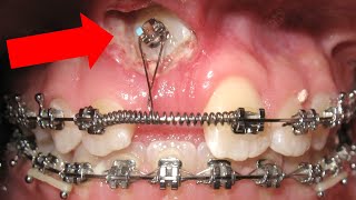 🔥Unexpected orthodontic impaction🔥 and OPEN BITE timelapse HOW BRACES WORK [upl. by Welton]