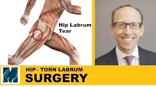 Hip Pain  Torn Labrum Hip [upl. by Nivlam]