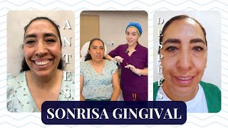 SONRISA GINGIVAL BÓTOX para dejar de mostrar las ENCÍAS al SONREÍR I MARISOL GÓNGORA [upl. by Nyletac85]