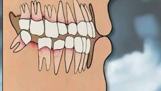 Dental Implants Pros amp Cons  YOU MUST SEE IT [upl. by Odell]