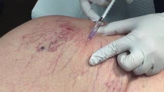 Dr Dima Performs Spider Vein Treatment with Sclerotherapy [upl. by Jacenta209]