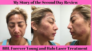 Day 2  Forever Young BBL and Halo Laser Treatment [upl. by Rafiq583]