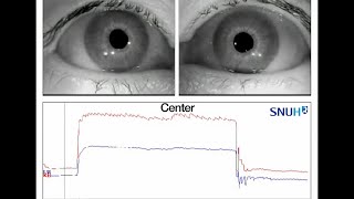 Bilateral Internuclear Ophthalmoplegia Observed in Anti–GQ1b Antibody Syndrome [upl. by Nyrat460]