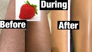 How to get rid of strawberry legs in 3 days with one cream [upl. by Perrie]