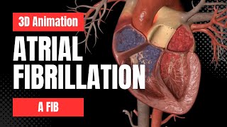 Atrial Fibrillation AFib  3D Animation [upl. by Nangem9]