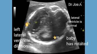 Mild unilateral dilation lateral ventricle in fetus unilateral ventriculomegaly ultrasound video [upl. by Elleneg]