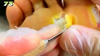 73Clean up large lesions on the soles of the feet [upl. by Richards767]