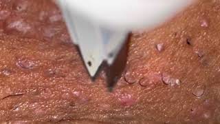 Ingrown Hair Removal 15 [upl. by Allenod227]