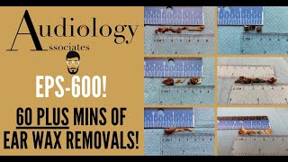 60  MINUTES OF EAR WAX REMOVALS  EP600 [upl. by Aiza615]