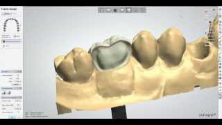 Anatomical Abutment Cut Back Screw Retained Crown [upl. by Deeraf]