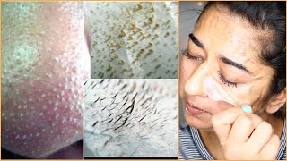 How to Instant Remove Blackheads and Facial Hair At Home  Indian Beauty Guru [upl. by Castor]