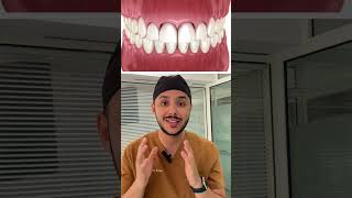 La solution pour le sourire gingival حل الابتسامة اللثوية souriregingivaldentistetanger [upl. by Sugihara]