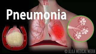 Pneumonia Animation [upl. by Leizahaj]