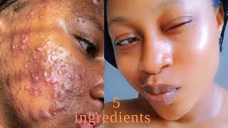 How to Remove Stubborn pimplesDark spotsAcneFast 5 ingredients Get a Glass skinclearacne [upl. by Derfnam]