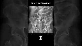 Postoperative ileus Abdominal Xray Abnormalities Postoperative ileus 66 radiologychannel007 [upl. by Rik]