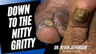 Down To The Nitty Gritty Trimming Fungal Toenails To Get To A Cure [upl. by Yttig]