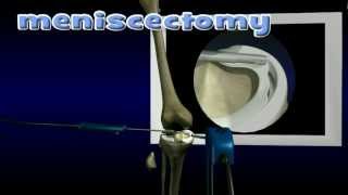 Meniscus Repair and Meniscectomy [upl. by Vaughan]