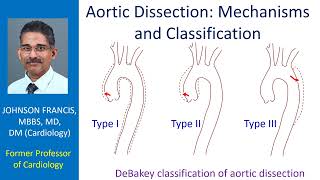 Aortic Dissection – Mechanisms and Classification [upl. by Okoyk]