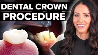 Same Day Dental Crown Procedure Step by Step [upl. by Amri637]