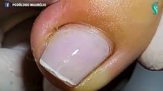 UNHA ENCRAVADA COM PUS INGROWN TOENAIL WITH PUS PODÓLOGO MAURÉLIO [upl. by Ettelrats427]