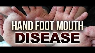 Hand Foot Mouth Disease Food Remedy [upl. by Llenrag]