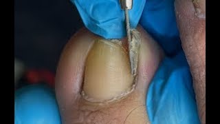 Huge ingrown toenail removal [upl. by Cowan943]