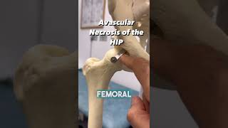 HOW DO YOU GET BONE NECROSIS OF THE HIP [upl. by Eenel]