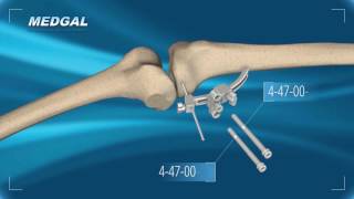 Tibial Osteotomy TECHNIQUE [upl. by Seed]