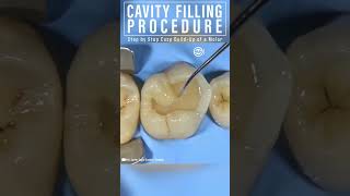 Dental Cavity Filling Procedure shorts medical tech dental teeth training [upl. by Tterrab]