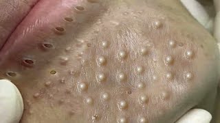 Big Cystic Acne Blackheads Extraction Blackheads amp Milia Whiteheads Removal Pimple Popping  6546 [upl. by Sams]