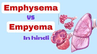 empyema vs emphysema  Difference between emphysema and empyema  nursing class in hindi  empyema [upl. by Koran]