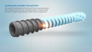 Acutrak 2 Headless Compression Screw System Overview [upl. by Auohs]