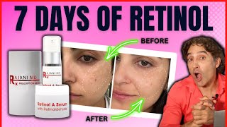 🔺RETINOL BEFORE And AFTER HALF Of HER FACE 🔺  Retinol Serum [upl. by Aleacin]