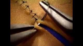 Basic Microsuture Technique [upl. by Cosmo]